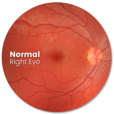 High intensity image of normal eye